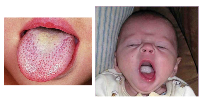بیماری های شایع دهان - برفک