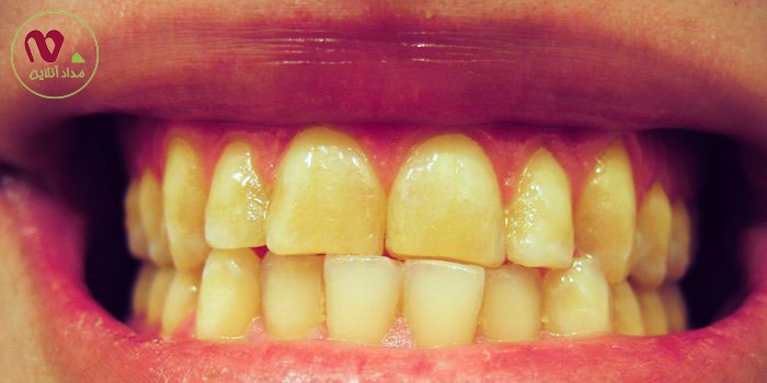 9 خوردنی که دندان هایتان را زرد می کنند