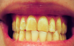 9 خوردنی که دندان هایتان را زرد می کنند